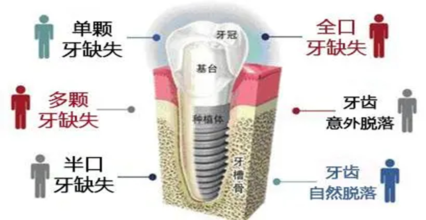 关于种植牙的知识误区