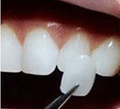 牙贴面牢固吗？是所有的牙齿都适用吗？