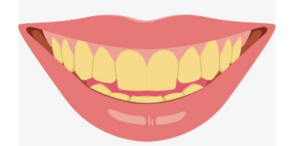 牙齿发黄是不是就是四环素牙呢？