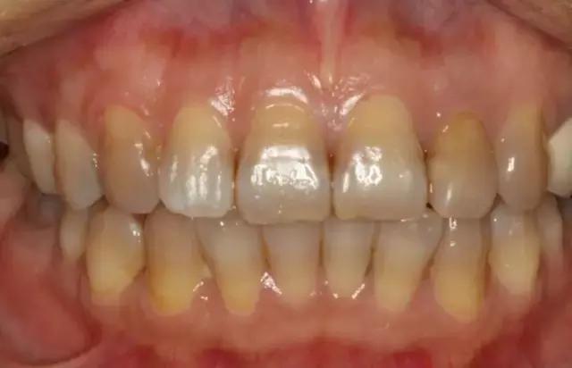 四环素变色牙前期有什么样的症状表现？