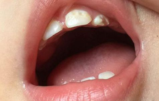 孩子牙齿有白斑，家长要警惕全口烂牙