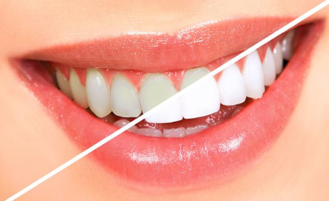 牙齿美白对牙齿有伤害吗？