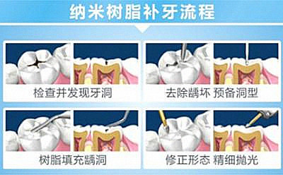 补牙并没那么复杂和可怕，补牙的流程了解下！