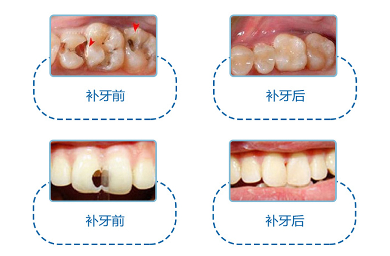 补牙材料该怎么选择？是不是越贵的越好？