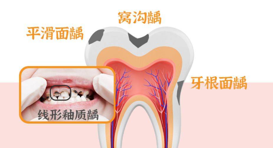 为什么！别人补牙几百，你补牙却要上万？