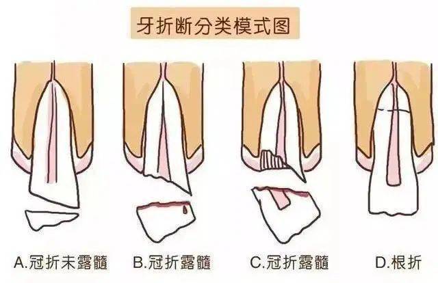 牙外伤分类和处理方法